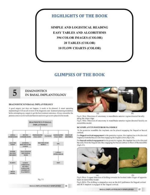 basal implantology simplife 6