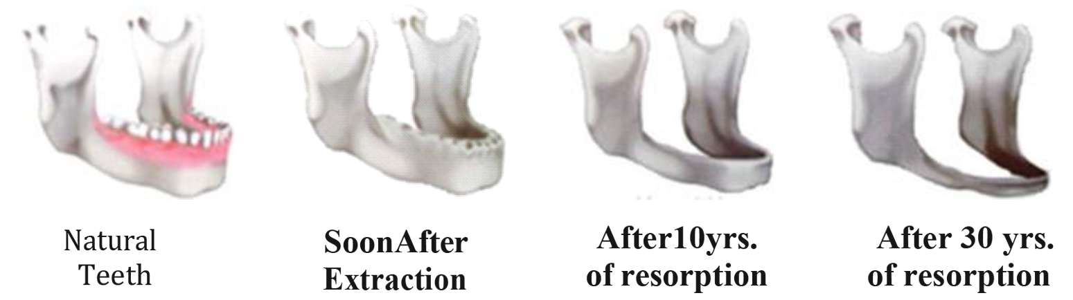 bone loss of teeth