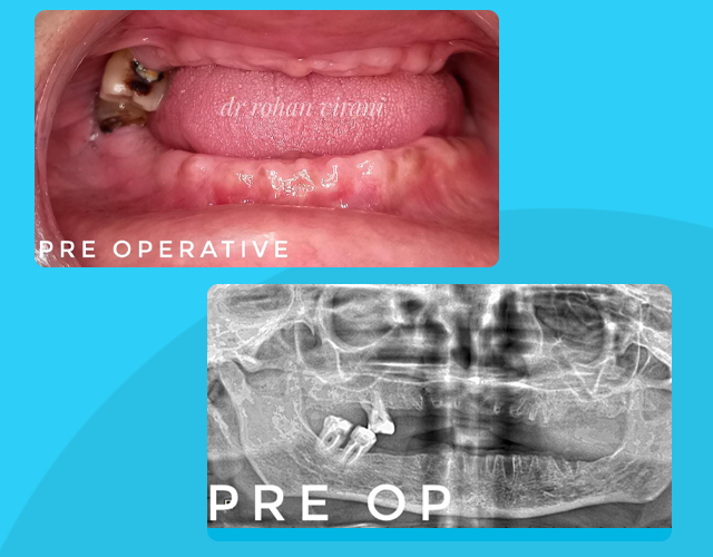pre operative