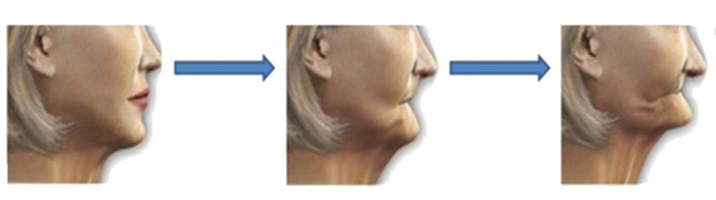 soft tissue collapse