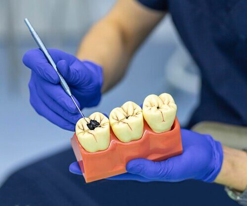 cavity tooth