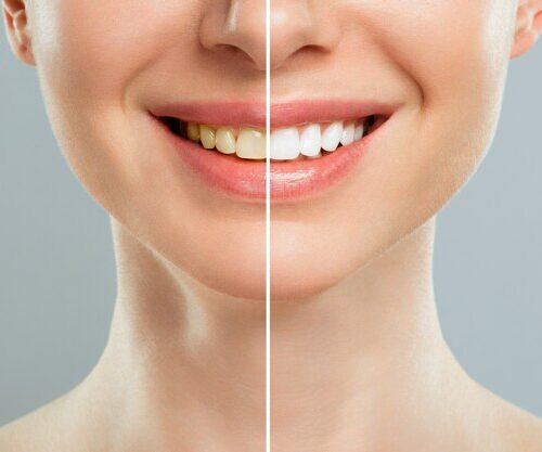 teeth whitening treatment