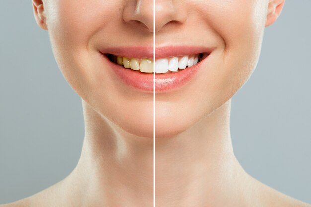 teeth whitening treatment