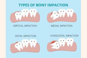 bony impaction of teeth