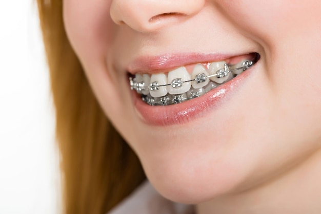 conventinal braces