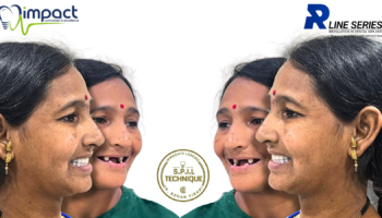 spil technique patient